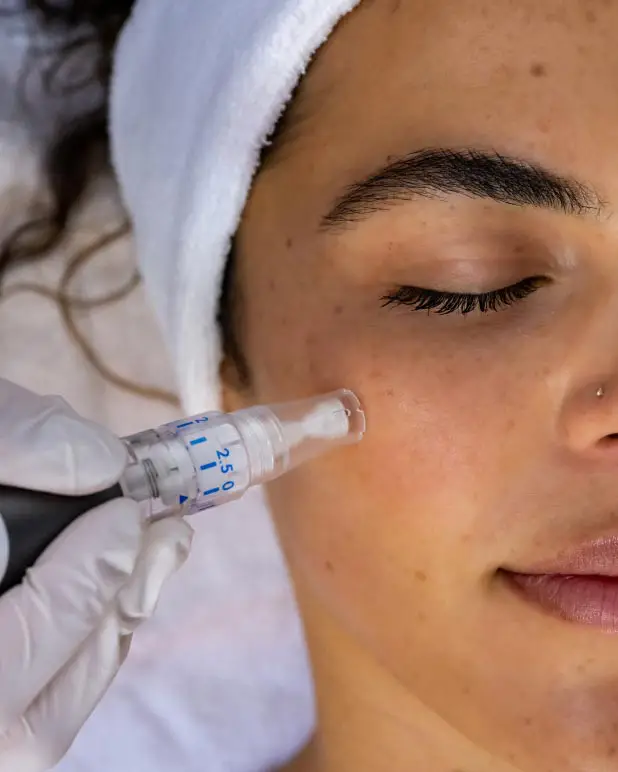 Microneedling treatment image